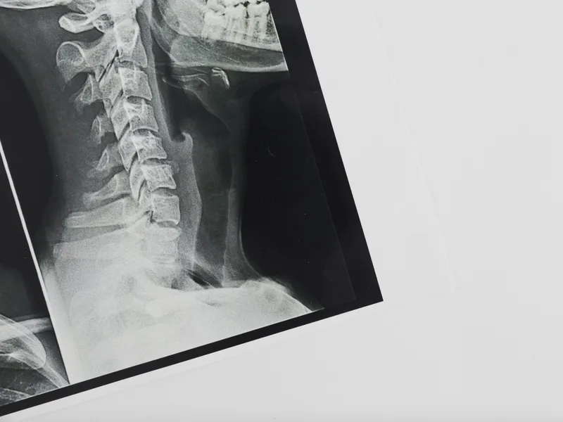 Spinal X-Rays at Chiropractic Fitness in Charlotte